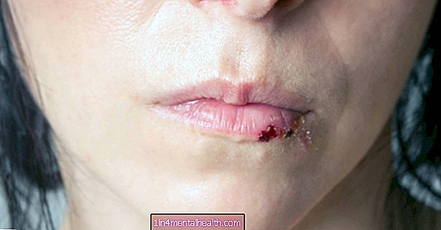 裂けた唇の原因と治療