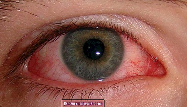 Koliko ste dugo zarazni ružičastim očima?