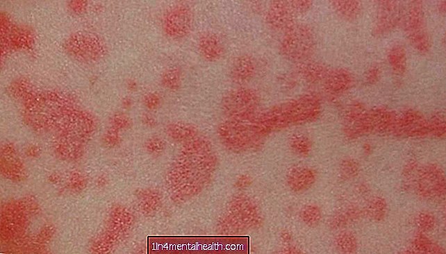 Bir amoksisilin döküntüsünden nasıl kurtulurum - alerji