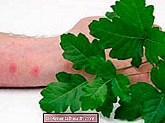 Cara mengenali dan merawat ruam oak racun - alahan