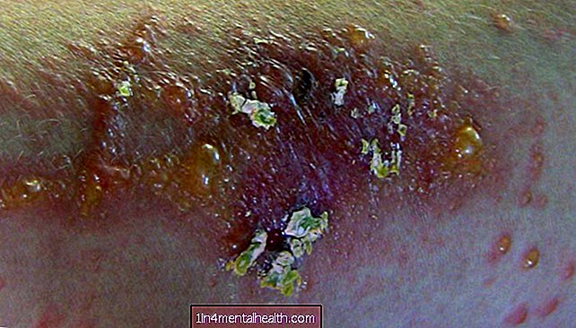 Erupción por hiedra venenosa: lo que hay que saber - alergia
