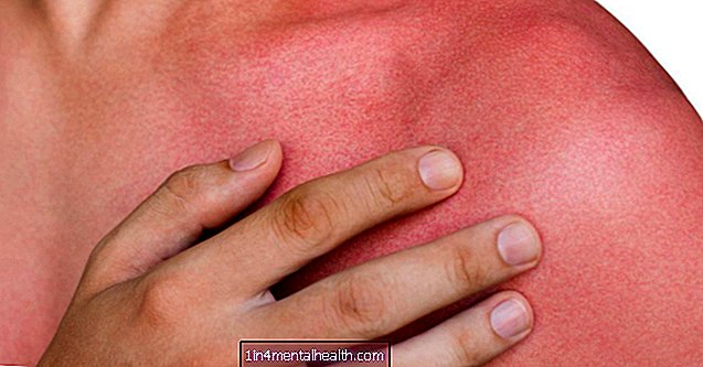 Wat kan een rode huid veroorzaken? - allergie