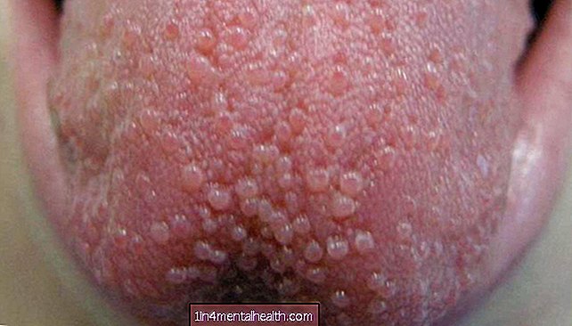 Hva forårsaker tungehopp? - allergi