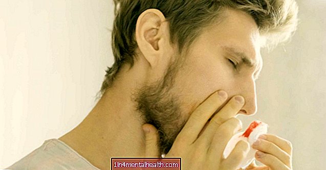 Kas jāzina par deguna asiņošanu ar recekļiem - alerģija