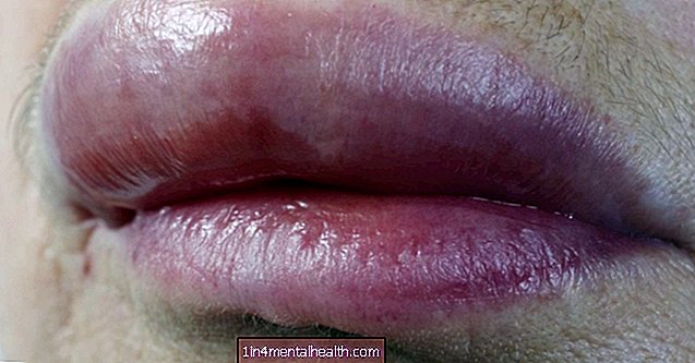 Waarom zijn mijn lippen opgezwollen? - allergie