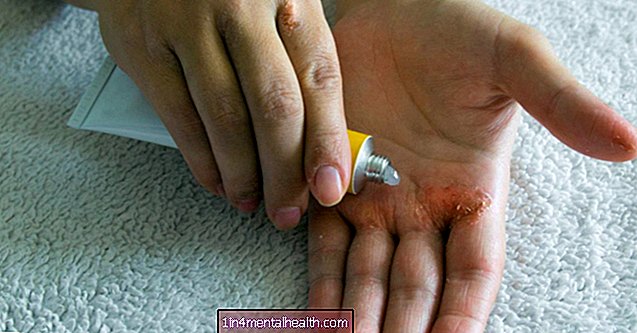 Hoe ernstig eczeem te behandelen - atopische dermatitis - eczeem