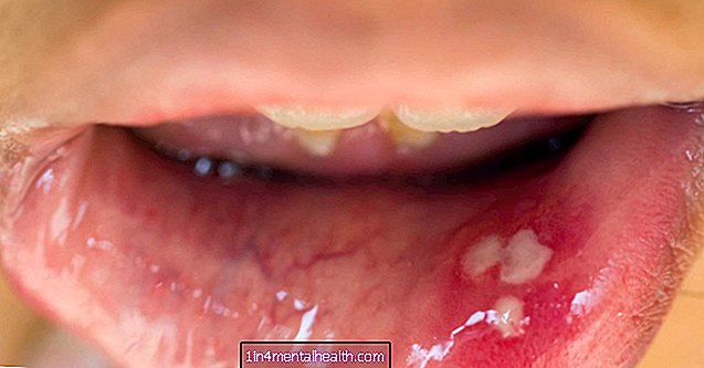 Как изглежда HPV в устата ви? - контрол на раждаемостта - контрацепция