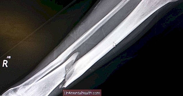 Apa yang perlu diketahui mengenai patah tulang tibia