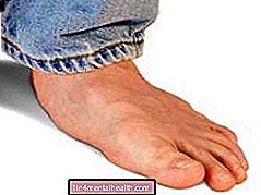 Hvad skal man vide om flade fødder? - knogler - ortopædi