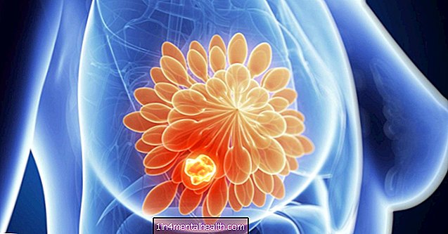 Cáncer de mama: crecimiento de tumores impulsado por células de la médula ósea