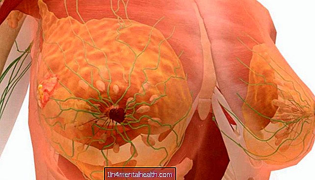 Какви са симптомите на рак на гърдата в стадий 4? - рак на гърдата