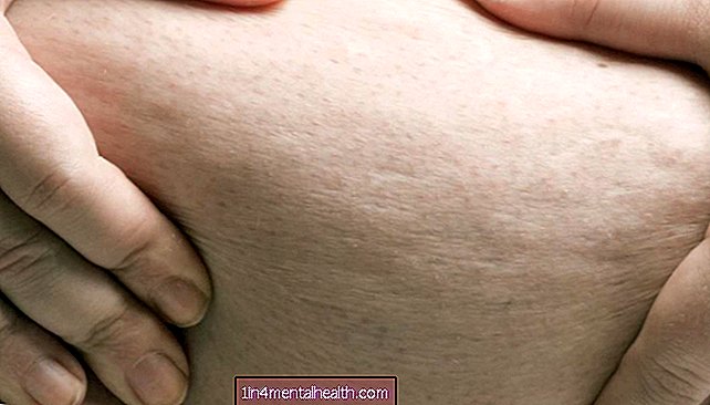 Što znati o peau d'orange - rak dojke