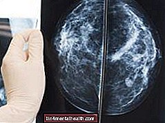 Kaj vedeti o trojno negativnem raku dojke - Rak na dojki