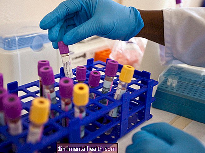 Hva er komplikasjonene av HIV? - kreft - onkologi