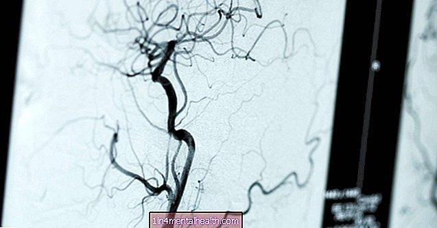 Kaj vedeti o angiogramih