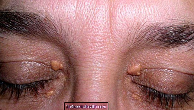 आंखों में कोलेस्ट्रॉल जमा होना: लक्षण और उपचार - कोलेस्ट्रॉल