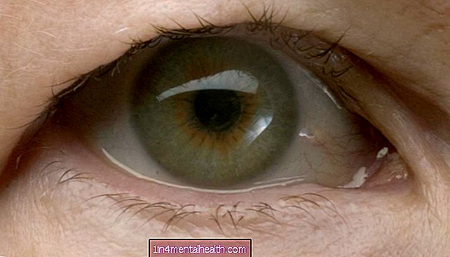 Hoe behandel je een hangend ooglid? - cosmetische geneeskunde - plastische chirurgie