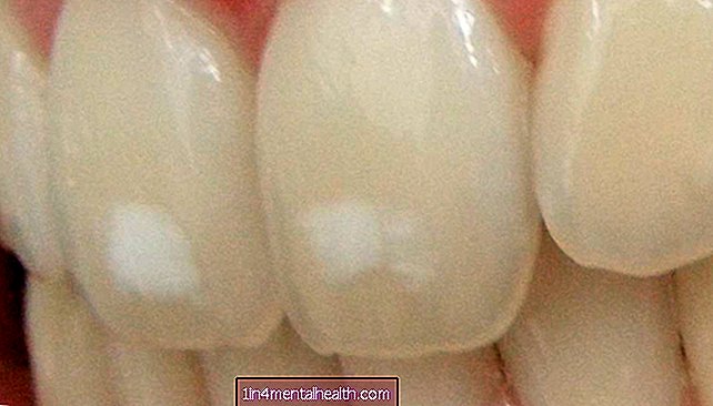 Once consejos para tratar las manchas blancas en los dientes - odontología