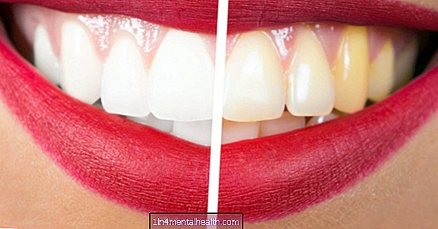 Domowe sposoby na pozbycie się żółtych zębów - stomatologia