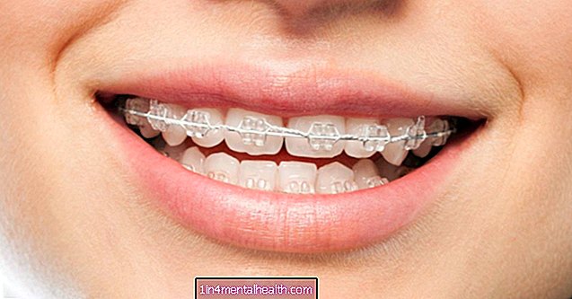 Kako lahko pomaga ortodontsko zdravljenje? - zobozdravstvo