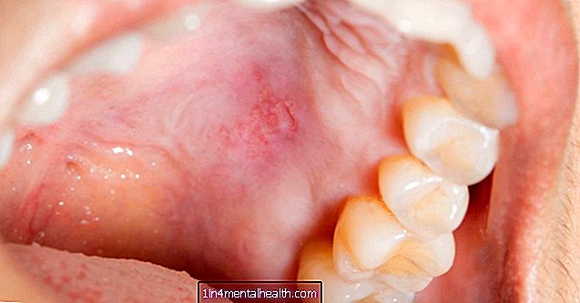 Što uzrokuje kvrgu na krovu usta? - stomatologija