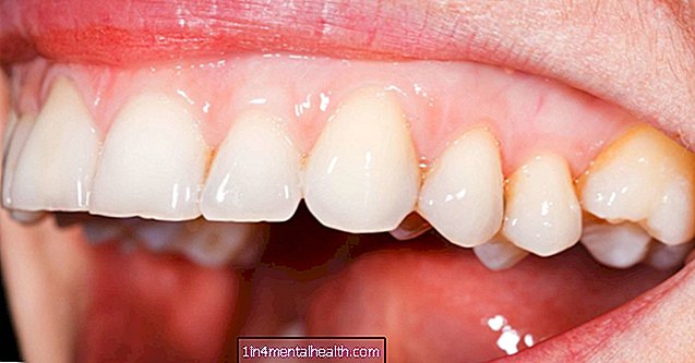 Kas sukelia blyškias dantenas? - odontologija