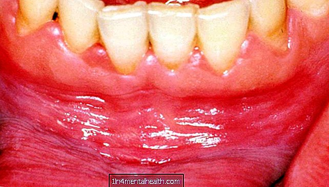 Ką tai reiškia, kai turite baltas dantenas? - odontologija