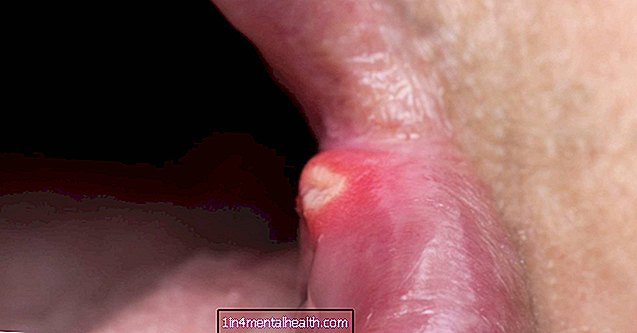 Wat u moet weten over zweertjes in de mond van chemo