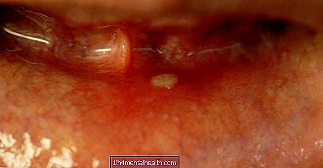 Varför ser tandköttet vitt ut? - tandvård