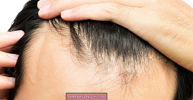 Tudo que você precisa saber sobre recuo da linha do cabelo - dermatology