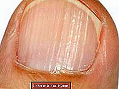 Sve što trebate znati o grebenima na noktima - dermatologija