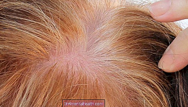 Bolehkah PRP merawat keguguran rambut?