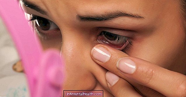 Göz kapağı cilt etiketlerinin nedenleri ve çıkarılması - dermatoloji
