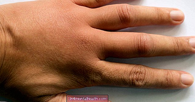 Årsager til hævede hænder - dermatologi