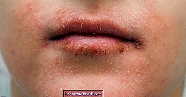입 주변의 건조한 피부 : 원인 및 치료