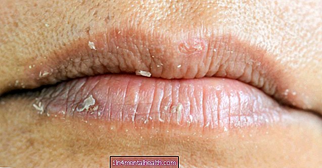 Eczéma sur les lèvres: causes et traitement