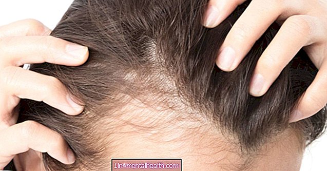 Kvinnlig håravfall: Behandling och genetik