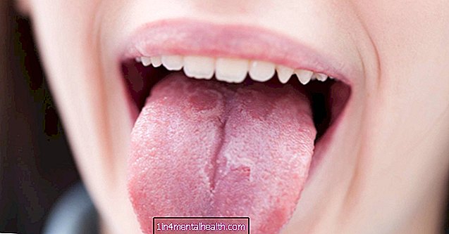 Hur kan psoriasis påverka munnen och tungan? - dermatologi