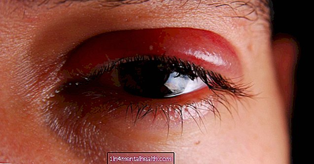 Cum poate afecta zona zoster ochii?