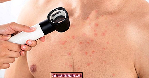 ¿Cómo deshacerse del acné en el pecho? - dermatología