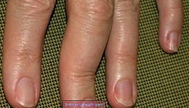 Viêm khớp vảy nến ảnh hưởng đến bàn tay như thế nào?
