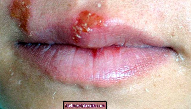 Jak identifikovat a léčit kožní vyrážku z herpesu