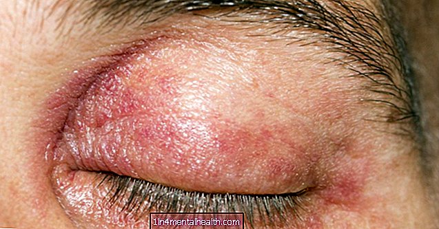 Cara mengenal pasti dan merawat dermatitis kelopak mata