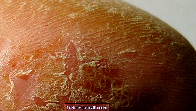 Cara mengenal pasti dan merawat kulit bersisik: Panduan gambar - dermatologi