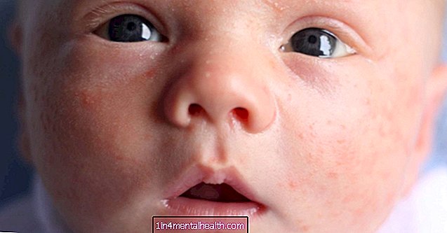 Hur man identifierar babyakne mot utslag - dermatologi