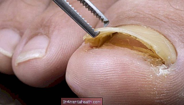Comment gérer un ongle détaché