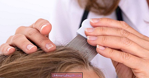 Kako ugotoviti razliko med ušmi in prhljajem - dermatologija