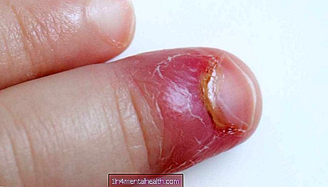 Sådan behandles paronychia (et inficeret negl) - dermatologi