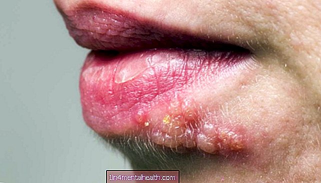 Cómo tratar el herpes zóster en la cara. - dermatología