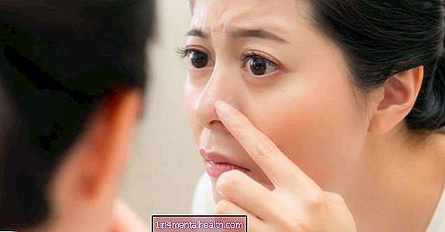 Ako liečiť biele bodky na nose - dermatológia